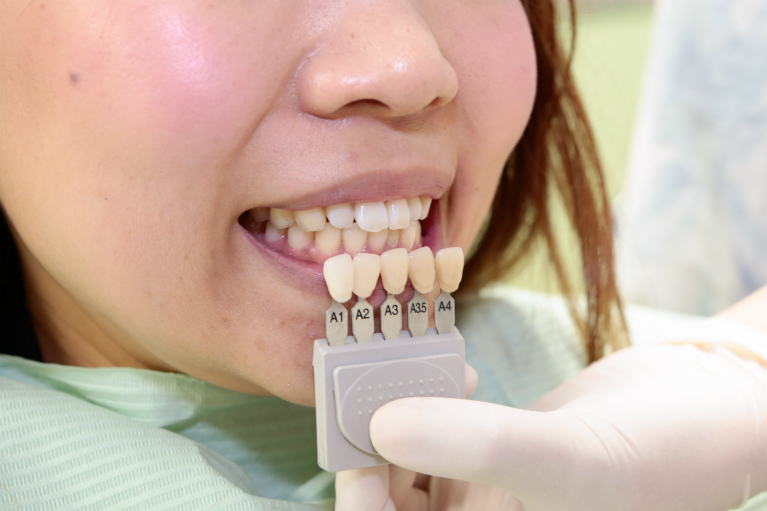 ホワイトニングについての説明、歯の表面をクリーニング
